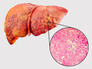 Estágio 1: Acúmulo de gordura nas células do fígado
